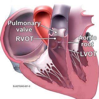 right ventricular outflow tract anatomy.